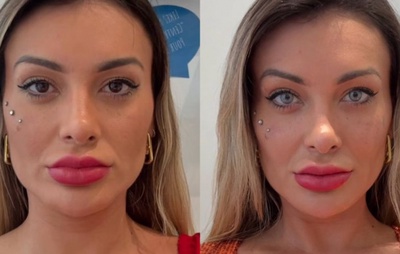 Andressa Urach relata arrependimento após cirurgia para mudar cor dos olhos