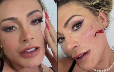 Andressa Urach levou quatro pontos no rosto após briga com Juju Ferrari: "Poderia ter me deixado cega"