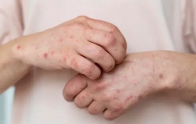OMS alerta para aumento de casos de antraz em humanos e animais