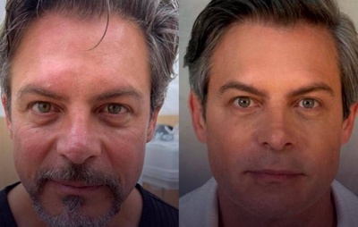 Luigi Baricelli choca fãs com resultado de harmonização facial: antes e depois impressiona