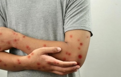 Anvisa Determina Divulgação de Informações sobre Mpox e Sarampo em Portos e Aeroportos