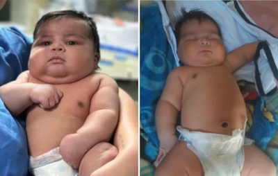Bebê gigante de 6,5 kg nasce em Colatina (ES) e enfrenta complicações após parto atípico
