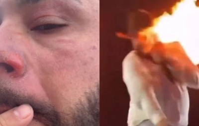 VÍDEO: Sertanejo mostra ferimentos após sofrer queimaduras com efeito especial em show